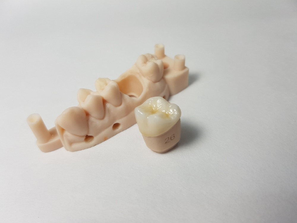 Digital Model and Zirconia Crown